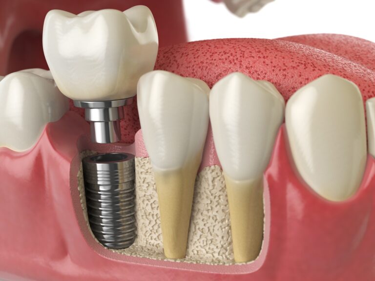 Anatomy of healthy teeth and tooth dental implant in human dentura. 3d illustration